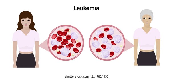 Leukemia Difference Blood Leukemia Normal Blood Stock Vector (Royalty ...