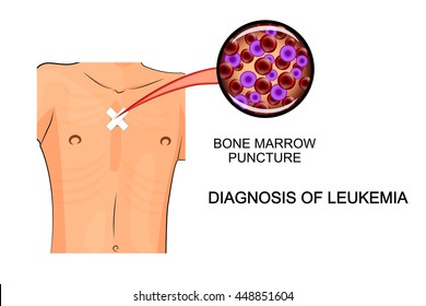 Leukemia. Illustration Of Analysis Of Bone Marrow Biopsy
