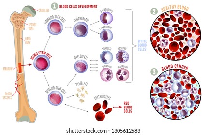Leukemia and normal blood under the microscope in comparison. Medical infographic. Blood cells production scheme. Vector illustration on a white background. Scientific concept. Horizontal poster.