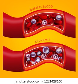 Leukemia and normal blood vessel in comparison. Medical infographic. Editable vector illustration isolated on orange background. Scientific and educaional concept. Square poster.