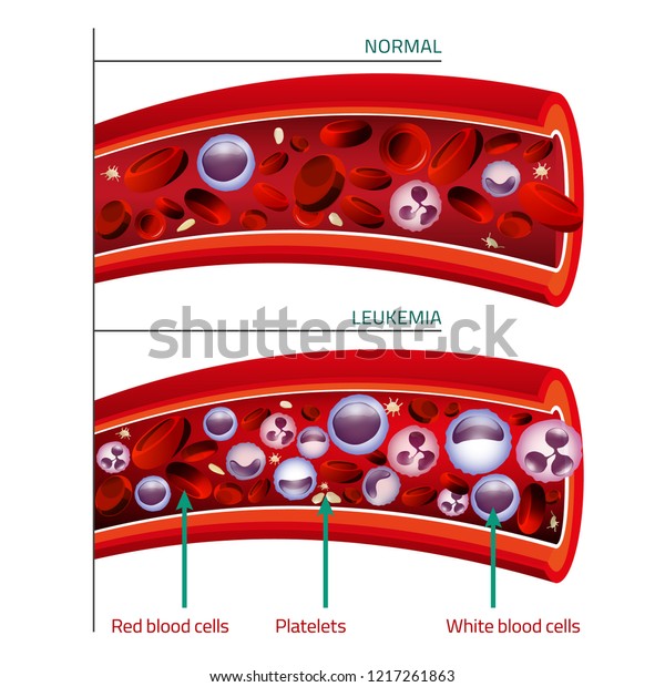 Leukemia Normal Blood Vessel Comparison Medical Stock Vector (Royalty ...