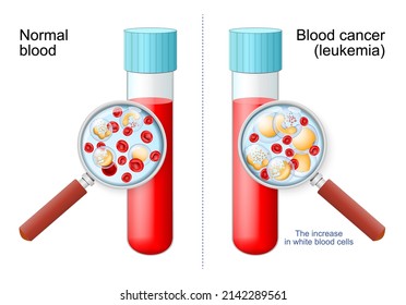 Leukemia. Red And White Blood Cell In Test Tube In Magnifying Glass. Comparison And Difference Between Healthy Blood And Blood Cancer. Close-up Of Erythrocytes, Monocyte, Basophil, Lymphocyte