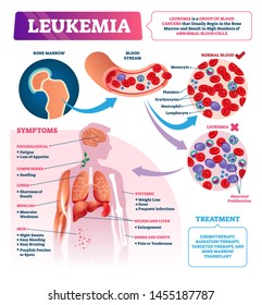 Leukemia Vector Illustration. Labeled Educational Blood Cancer Infographic. Bone Marrow And Abnormal Cells Disease. Medical Diagnosis Symptoms And Ill Treatment List. Compared Normal And Sick Closeup.