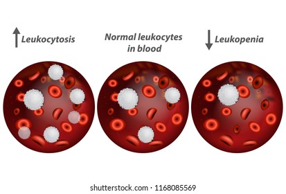 Leukocytosis And Leukopenia. White Blood Cell Count. 