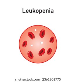 Leukopenia Concept Design. Vector Illustration.