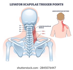 Levator scapulae trigger points illustrated with muscle highlights and referral pain path on neck and shoulder, key elements, levator scapulae muscle, cervical spine, scapula. Outline diagram