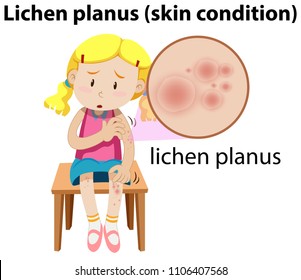 Lichen planus maginfied on girl illustration