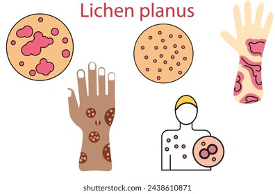 Lichen planus,non-infectious, itchy rash that can affect many areas of the body,skin illustration,arms, legs and trunk,fungus,Skin Problem