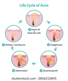 The life cycle of acne icon set illustration. Pimple forms when excess skin oil and dead skin cells clog hair follicle. Propionibacterium acnes growth, causing inflammation, healing and leaving scar.