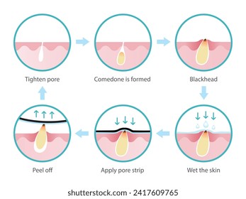 Life cycle of blackhead removal vector isolated on white background. Cross section of diagram blackhead pore skin, comedone is formed, expand to non inflammatory acne, treatment with pore strip.