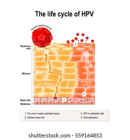 life cycle of hpv in the human epithelium. hpv - Human papillomavirus infection which causes warts and cervical cancer (carcinoma of Cervix) - Malignant neoplasm arising from infected epithelial cells