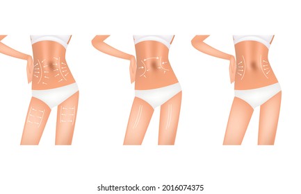 Levantamiento, flechas de acción del aparato, cuerpo realista, ilustración del vector médico. Eliminación de la grasa corporal.