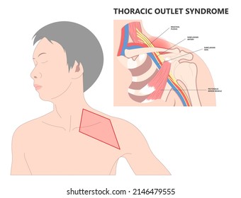 Lifting Heavy Objects Trauma Of Pinched Vagus Nerve Rib Bone Neck Arm Hand Pain Carpal Tunnel Outlet Minor T4 Poor Artery Blood Clots Adson's Test