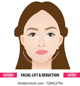 Lifting and wrinkle injection surgery vector illustration