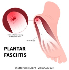 Ligament injury with heel pain and swelling in medical called Plantar Fasciitis of flat feet syndrome