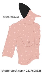 light brown spots on the skin or Neurofibroma spinal cord Freckles disease