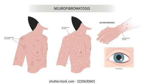 light brown spots on the skin or Neurofibroma spinal cord Freckles disease