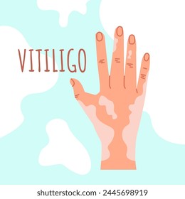 Una mano de piel clara con despigmentación del vitíligo. Un afiche de Asistencia a personas que sufren de vitíligo. El concepto de amor propio, positividad corporal. Ilustración vectorial