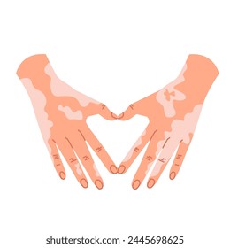 Light-skinned human hands depigmented from vitiligo, forming a heart-shaped symbol. A gesture of the heart with two palms. Self-love, body positive. Vector illustration in a flat style