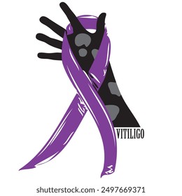 The lilac ribbon is a symbol of Vitiligo manifested in a color change on the skin.