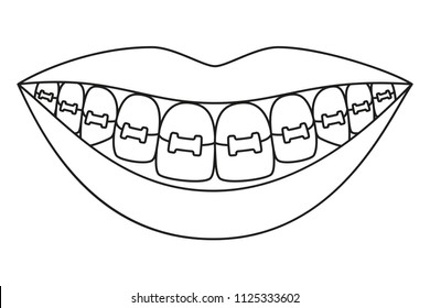 Line art black and white healthy smile in braces. Coloring book page for adults and kids. Dental care vector illustration for icon, sticker, label, badge, certificate, leaflet or banner decoration