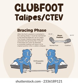 Vector de arte de línea de pie de club. Método Ponseti. Los pies se vuelven hacia adentro o hacia arriba. Fase de frenado de pie de club, zapatos ortopédicos