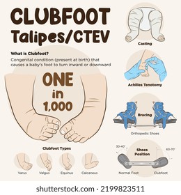 Line art vector of the process of clubfoot treatment. Ponseti Method. Clubfoot infographic.