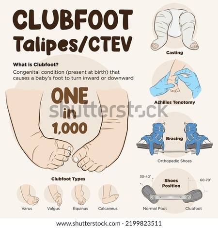 Line art vector of the process of clubfoot treatment. Ponseti Method. Clubfoot infographic.