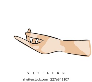 Vector de arte de línea de conciencia de vitiligo. 