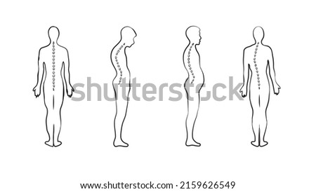 the line drawing of human vertebral deformities 
-Types of spinal deformities: a side-to-side curve is called scoliosis; a forward curve (kyphosis) shifts the center of balance in front of the hip.
