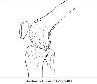 Line Drawing Of Knee Osteoarthritis 
-The Cartilage In The Knee Joint Gradually Wears Away. 