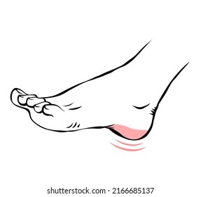 308 Plantar Fasciitis Stock Vectors, Images & Vector Art | Shutterstock