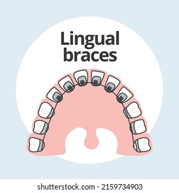 Lingual Braces Orthodontist vector illustrator