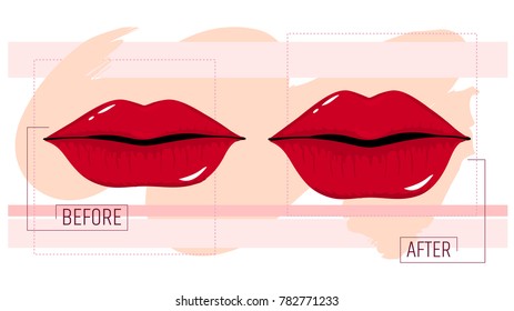 Lip augmentation. before and after the cosmetology procedure.