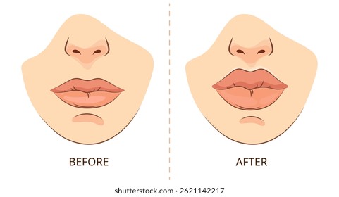 Lip Augmentation Before and After .Female lips before and after cosmetic augmentation beauty clinic presentations aesthetic treatment infographics medical brochures, cosmetic surgery ads Vector 