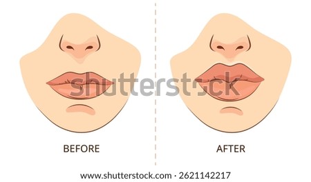 Lip Augmentation Before and After .Female lips before and after cosmetic augmentation beauty clinic presentations aesthetic treatment infographics medical brochures, cosmetic surgery ads Vector 
