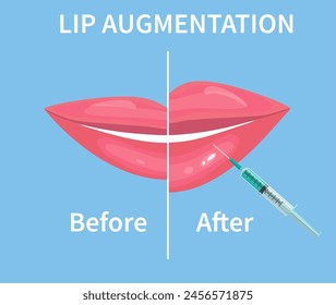 Aumento De Labios. Antes y después de las inyecciones de relleno labial. Inyecciones de ácido hialurónico. Ilustración vectorial en estilo plano