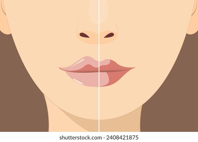 Lip-Augmentation und -Korrektur. Füller-Injektionen anheben. Hyaluronsäure. Kosmetologie-Verfahren in einem Schönheitssalon