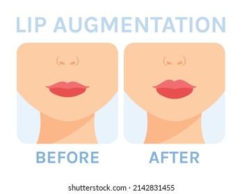 Lip Augmentation with Filler. Before After. Thin Beautiful Female lips. Cosmetic Procedure. Perfect Sexy Lush lips. Cartoon color style. White background. Vector illustration for Medical Beauty design