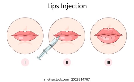 lip augmentation filler procedure diagram hand drawn schematic vector illustration. Medical science educational illustration