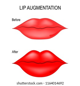 Lip Augmentation. Procedure of Lips ingection. injectable cosmetic filler. Vector illustration for biology, scientific, skincare, and medical use.