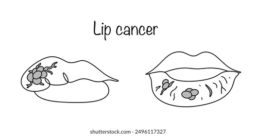 Lip cancer. A malignant tumor of the elements of the integumentary epithelium of the red border of the lips. Severe, progressive cancer. Vector.
