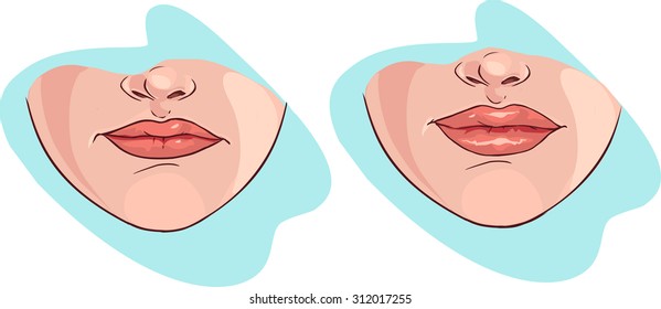 lip filler