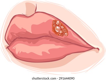 Lip Herpes