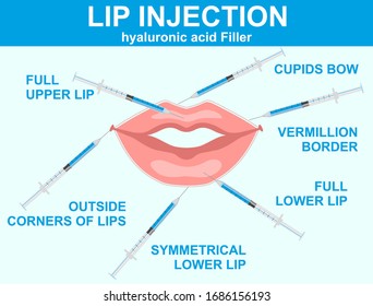 Lip injection hyaluronic acid filler. Hyaluronic acid lip injections scheme. Detailed anatomical zones infographic in colours. Medical, cosmetological and anti-aging concept. Vector illustration.