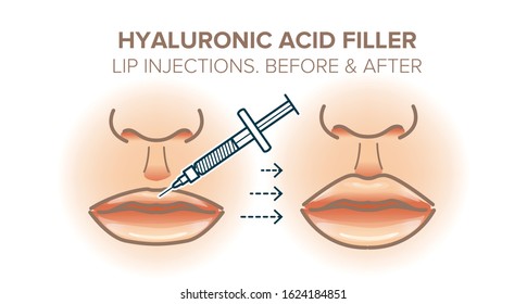 Lip injections. Hyaluronic acid filler. Before and after. Vector illustration for your design