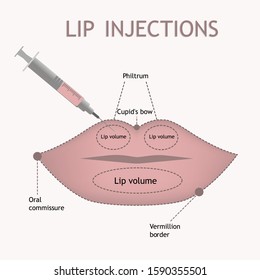  Lip injections scheme in flat style .Vector image of lip augmentation procedure with detailed anatomical zones info graphic.