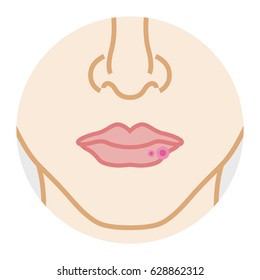 Lip Problem Cold Sore - Face Close-up Illustration