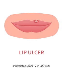Lip ulcer oral disease icon. Lips inflammation, irritation, and ulceration with cracked and peeling skin. Painful sores, blisters, lesions. Dermatitis outbreak. Medical concept. Vector illustration.