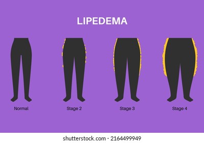 Lipedema disease concept. Accumulating fat in the lover part of the female body. Buttocks, hips and calves problems. Cellulite, overweight and swollen. Adipose tissue disorder flat vector illustration svg